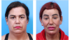 UCSF FPRS Facial Feminization Surgery