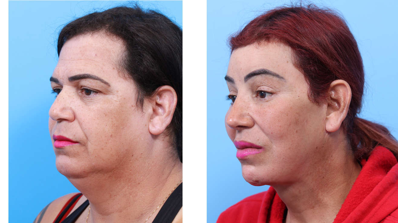 Facial Feminization Surgery: Before and After Gallery