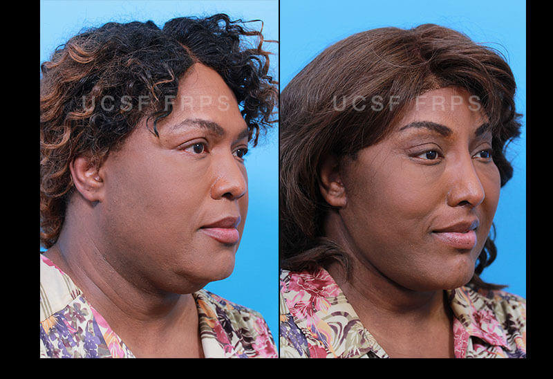 Facial Feminization Surgery: Before and After Gallery, Otolaryngology