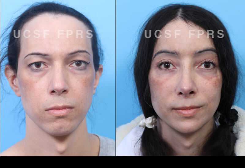 Facial Feminization 