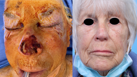 UCSF FPRS Mohs Case 4 (Disclaimer: Some viewers may find the following images disturbing.)