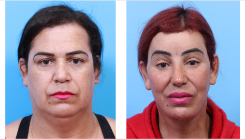 UCSF FPRS Facial Feminization Surgery