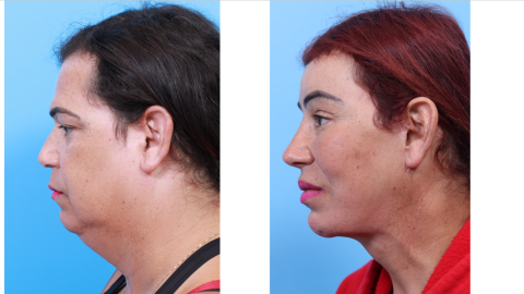 UCSF FPRS Facial Feminization Surgery