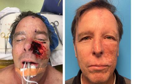 UCSF FPRS Mohs Case 6 (Disclaimer: Some viewers may find the following images disturbing.)