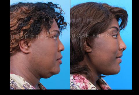 UCSF FPRS Facial Feminization Surgery