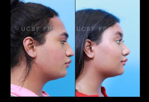 UCSF FPRS Facial Feminization Surgery