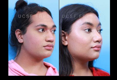 UCSF FPRS Facial Feminization Surgery