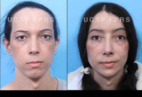 UCSF FPRS Facial Feminization Surgery