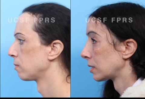 UCSF FPRS Facial Feminization Surgery