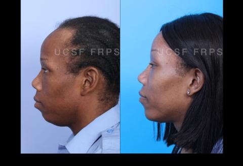 UCSF FPRS Facial Feminization Surgery