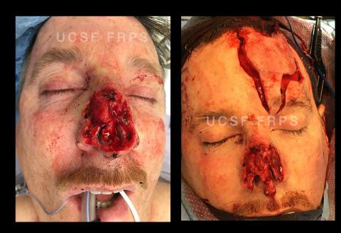 UCSF FPRS Mohs Case 1 (Disclaimer: Some viewers may find the following images disturbing.)