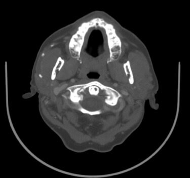 parotid-stone