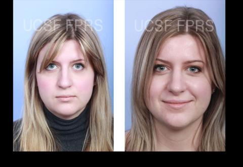 UCSF Rhinoplasty: Case 5