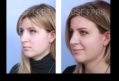 UCSF Rhinoplasty: Case 5