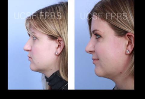 UCSF Rhinoplasty: Case 5