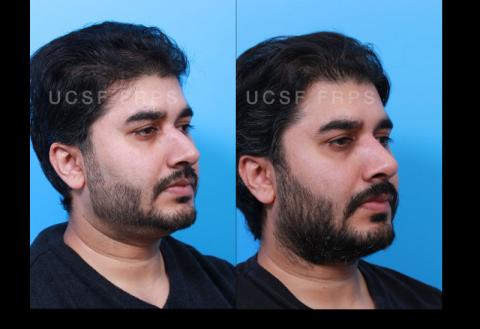 UCSF Rhinoplasty: Case 6