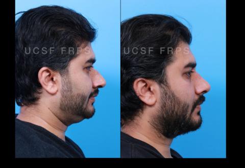 UCSF Rhinoplasty: Case 6