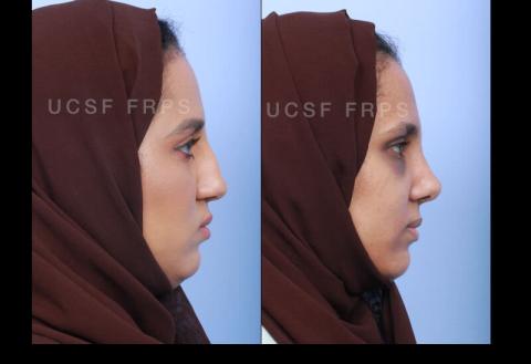 UCSF Rhinoplasty: Case 7