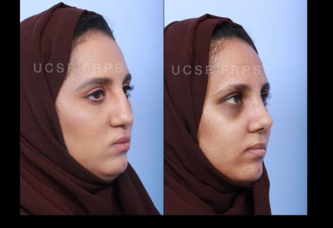 UCSF Rhinoplasty: Case 7