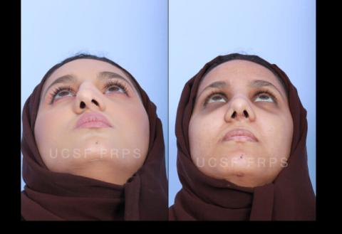 UCSF Rhinoplasty: Case 7