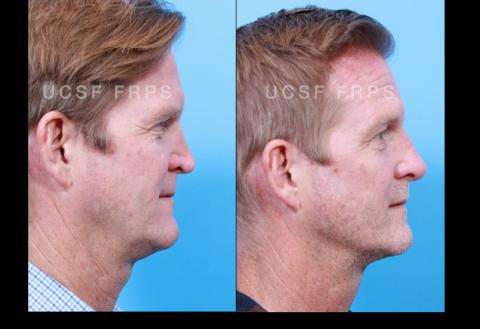 Revision Rhinoplasty: Case 1