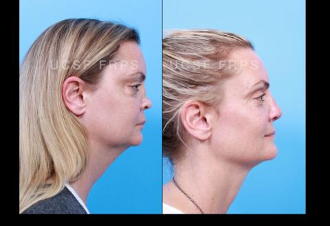 UCSF Rhinoplasty: Case 8