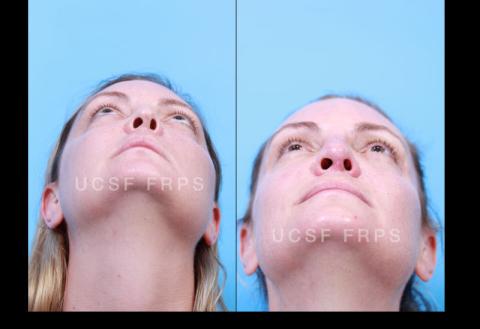 UCSF Rhinoplasty: Case 8