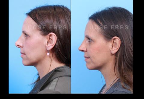 Revision Rhinoplasty: Case 2