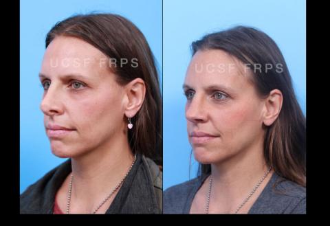 Revision Rhinoplasty: Case 2