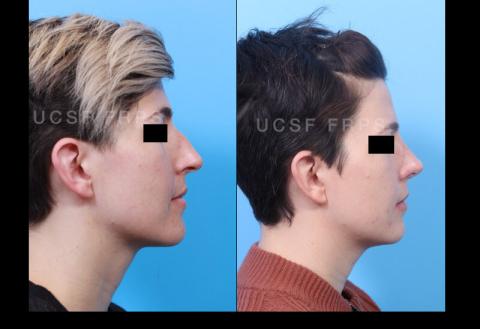 UCSF Rhinoplasty: Case 9