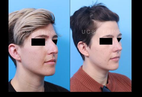 UCSF Rhinoplasty: Case 9