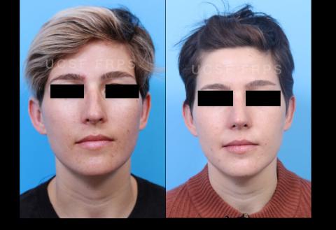 UCSF Rhinoplasty: Case 9