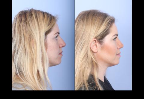 Full Face Contouring Before & After Photo Gallery, San Francisco, CA