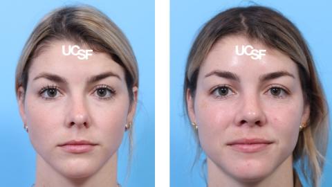 Rhinoplasty case 10