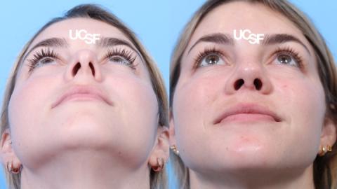 Rhinoplasty case 10