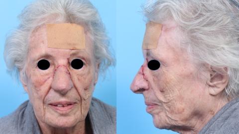 Mohs Nasal Forehead Flap