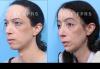 UCSF FPRS Facial Feminization Surgery