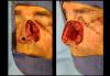 UCSF FPRS Mohs Case 2 (Disclaimer: Some viewers may find the following images disturbing.)